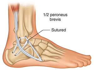 Ankle Instability Ankle Sprain Springerlink