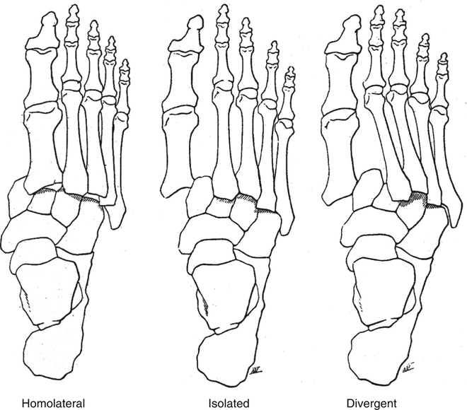 Chopart and Lisfranc Fracture-Dislocations | SpringerLink