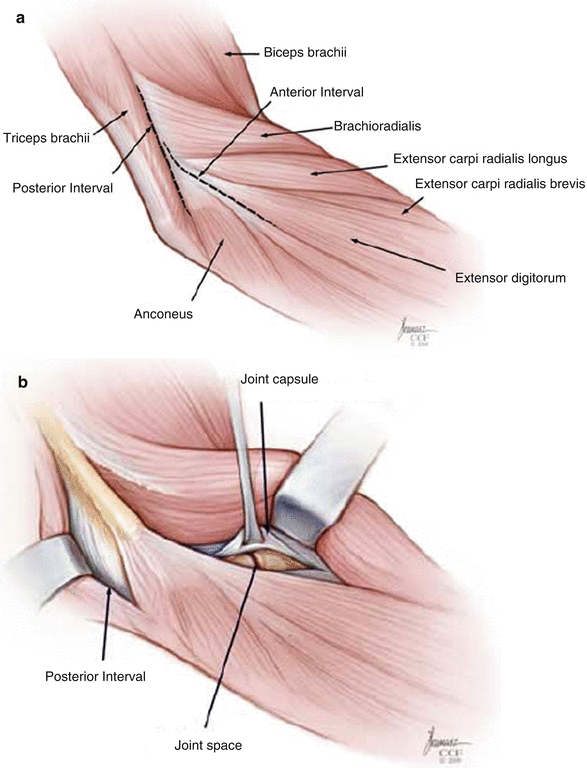 Arthrotomy Elbow