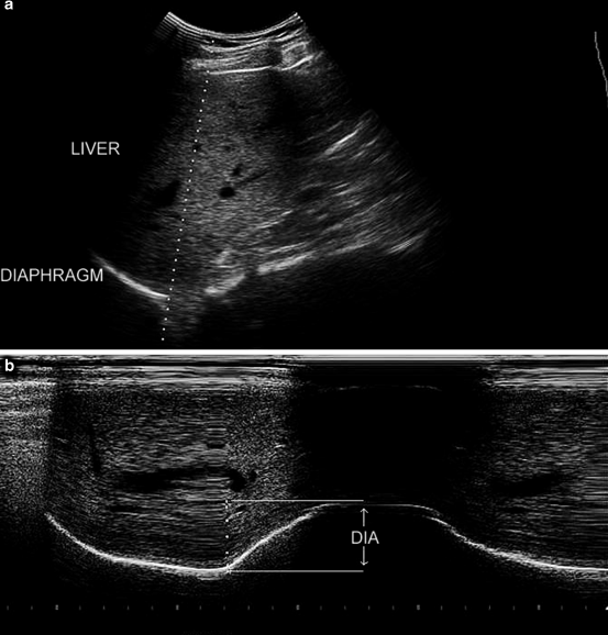 Diaphragmatic Ultrasound in Critically Ill Patients SpringerLink
