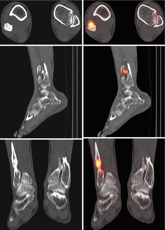 SPECT/CT in Orthopedics | SpringerLink