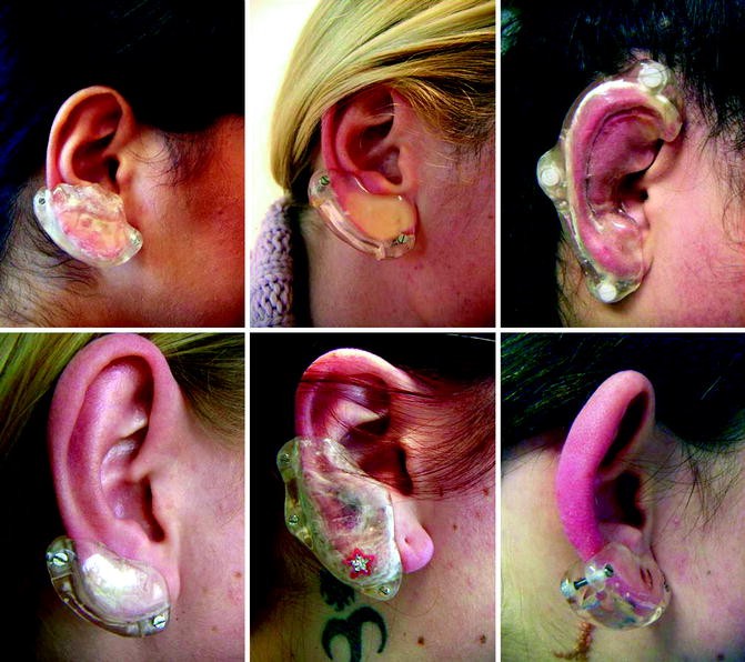Pressure Earrings For Keloid Cartilage Best Sale  renuvidyamandirin  1693446122