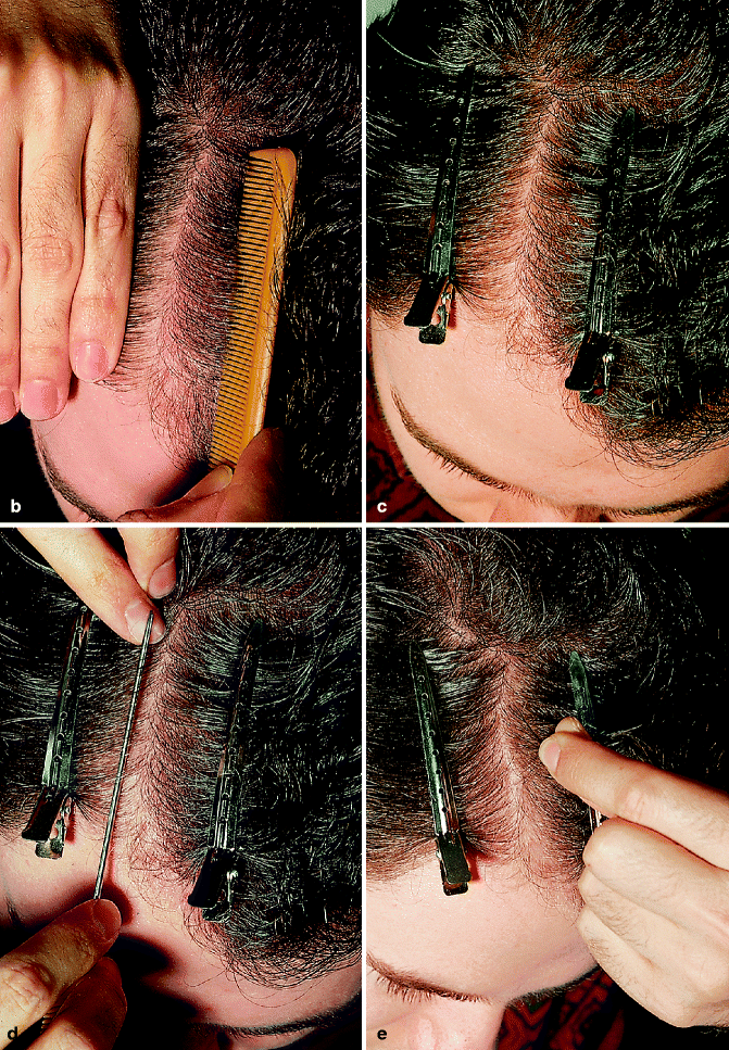 Examining Hair Loss In Women Springerlink