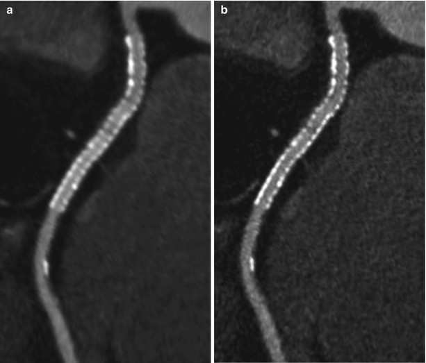 Imaging Of Coronary Revascularization Stent And Cabg Springerlink