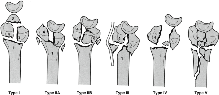 Distal Radius Fractures | SpringerLink