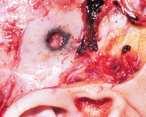 Gunshot And Blast Wounds Springerlink Gunshot And Blast Wounds Springerlink