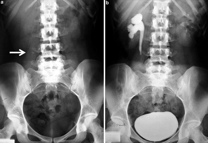Röntgen der Niere, des Retroperitoneums und der Harnblase | SpringerLink