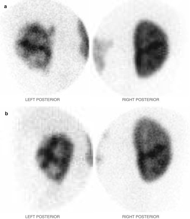Neonatal Urinary Tract Infection | SpringerLink Neonatal Urinary Tract Infection | SpringerLink