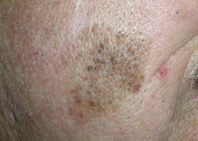 Malignant Melanoma Springerlink