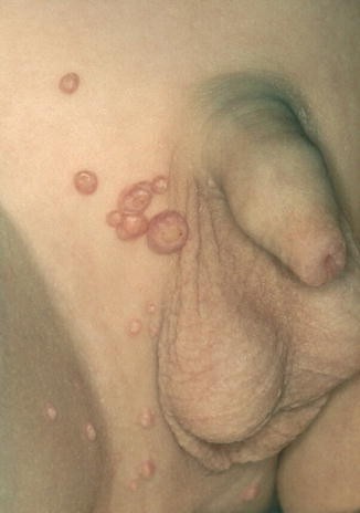 Penis Verbreiterung Penis Verbreiterung