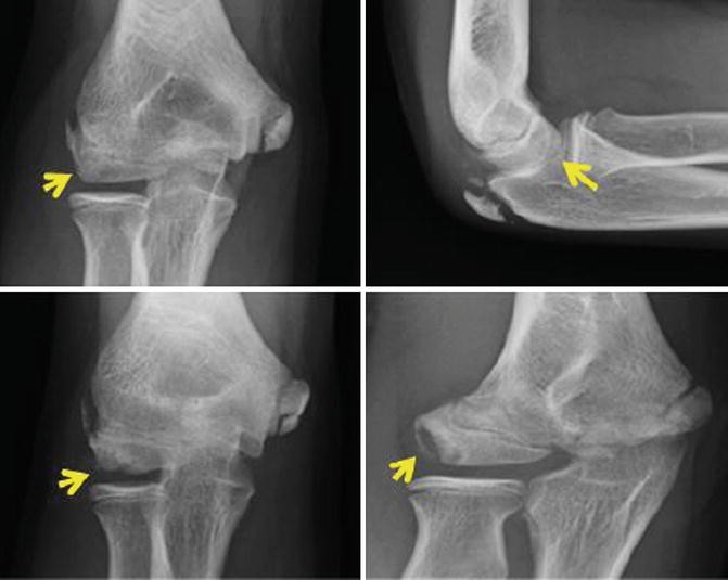 Osteochondritis Dissecans of the Throwing Elbow | SpringerLink