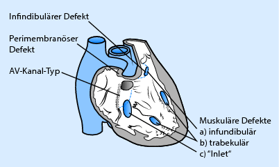 Angeborene Herz Und Gefassanomalien Springerlink