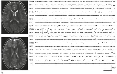 Epilepsien Bei Strukturellen Anomalien Des Gehirns Springerlink