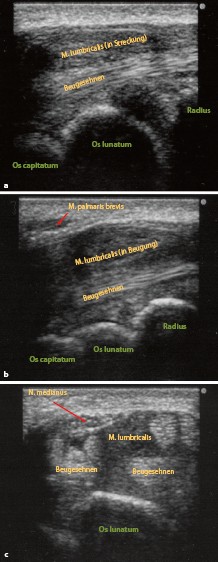 Sonografie Des Entzündlich Degenerativ Und Kompressiv - 