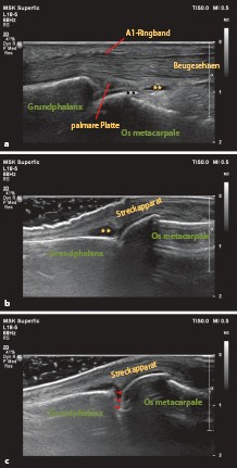 Sonografie Des Entzündlich Degenerativ Und Kompressiv - 