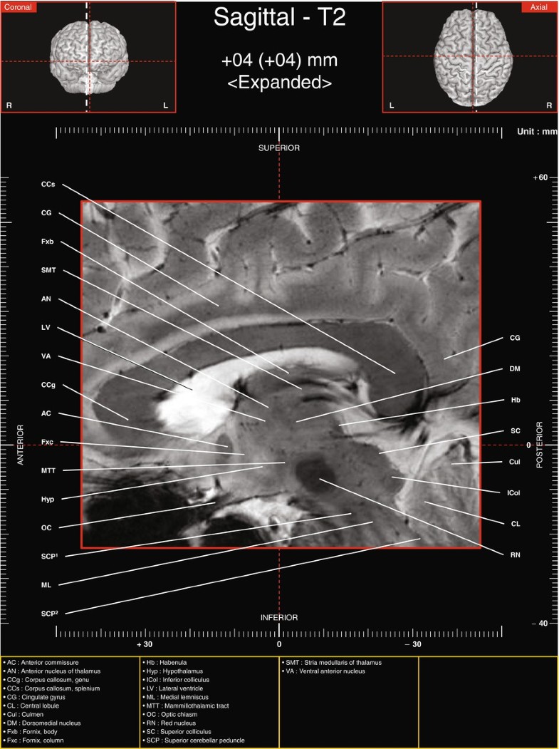 Sagittal Images Of Tractography And Corresponding In Vivo 7 0 T Mri Anatomy Springerlink