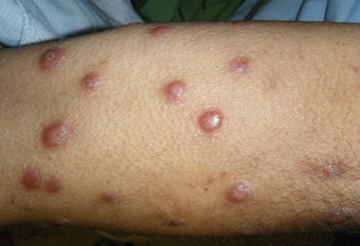 Skin Signs of HIV Infection | SpringerLink