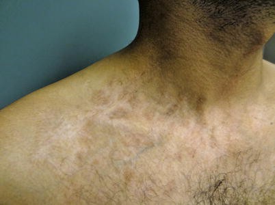 Post-inflammatory Hyperpigmentation | SpringerLink