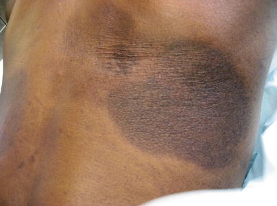 Post-inflammatory Hyperpigmentation | SpringerLink