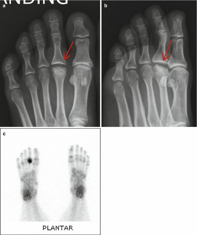Tratamentul osteocondrozei lombare a remediilor populare