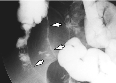 Inflammatory Disease Of The Small Bowel Springerlink