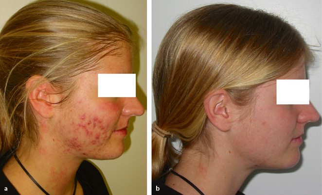 chemical peeling side effect chemical peeling side effect