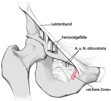 Spannungsfreie Mitturethrale Vaginalschlingen Springerlink