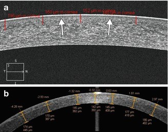 imaging after cornea surgery