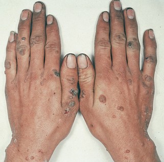 hpv virus finger