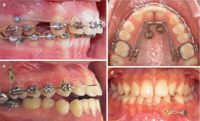Orthodontic Implants And Orthodontic Implant Surfaces Springerlink