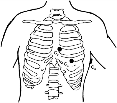 Kanal ekg kleben 12 EKG im