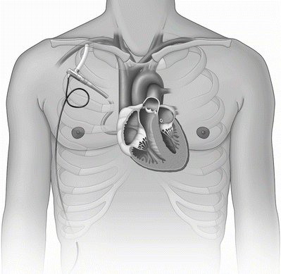 Mechanische Herzunterstutzungssysteme Springerlink