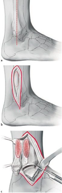 Tibiotalokalkaneare Ttc Arthrodese Mit Retrogradem Nagel Springerlink Tibiotalokalkaneare Ttc Arthrodese Mit Retrogradem Nagel Springerlink