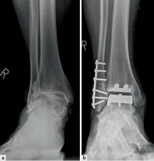 [DOC] Sprunggelenk und ruckfuss meistertechniken in der operativen orthopadie und unf allchirurgie