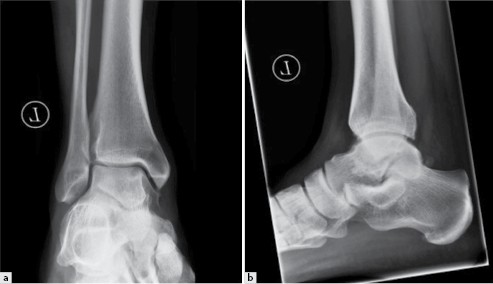 Osteochondrale Lasion Des Talus Springerlink Osteochondrale Lasion Des Talus Springerlink