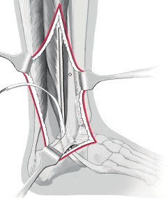 Distale Anatomische Syndesmosenplastik Springerlink Distale Anatomische Syndesmosenplastik Springerlink