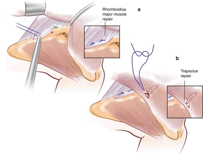 Anatomy of Scapula Winging | SpringerLink