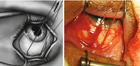 Orbital Floor Fractures Springerlink