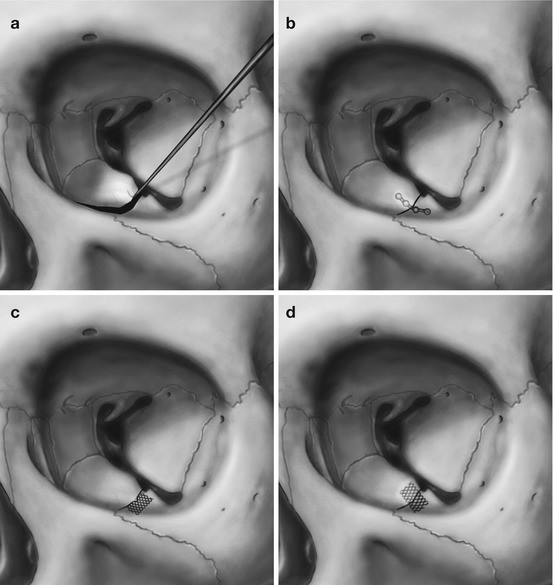 Orbital Floor Fractures Springerlink