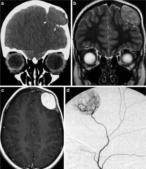 congestion of the brain 9 months old congestion of the brain 9 months old