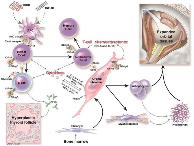 Thyroid Eye Disease A Comprehensive Review Springerlink