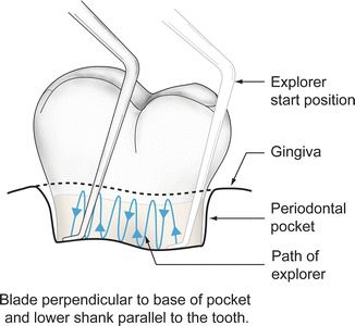 Instrumentation For Diagnosis And Basic Treatment Of Gingivitis Periodontitis Springerlink Instrumentation For Diagnosis And Basic Treatment Of Gingivitis Periodontitis Springerlink