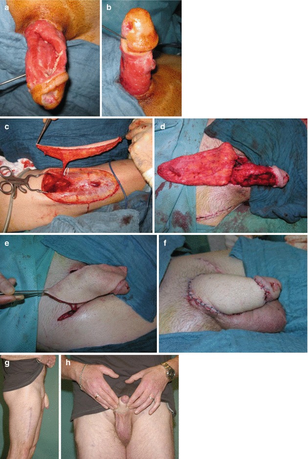 Penile Reconstruction of Amputated Penis | SpringerLink Penile Reconstruction of Amputated Penis | SpringerLink