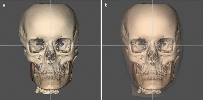 Clinical Applications Of 3d Virtual Treatment Planning Of Orthognathic Surgery Springerlink