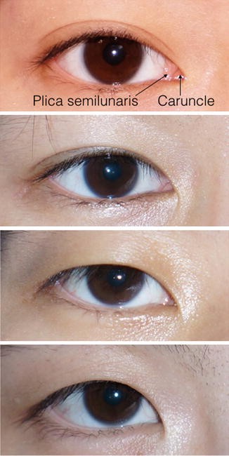 Update On Asian Eyelid Anatomy And Periocular Aging Change