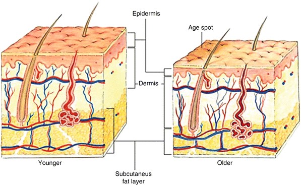 Degenerative Changes in Aging Skin | SpringerLink Degenerative Changes in Aging Skin | SpringerLink