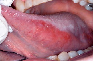photo Tongue Diseases Pictures diseases of the tongue springerlink