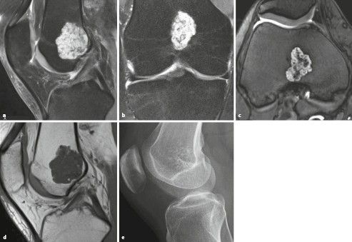 Primare Und Sekundare Knochengeschwulste Springerlink