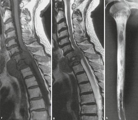 Skelettveranderungen Bei Hamatologischen Systemerkrankungen