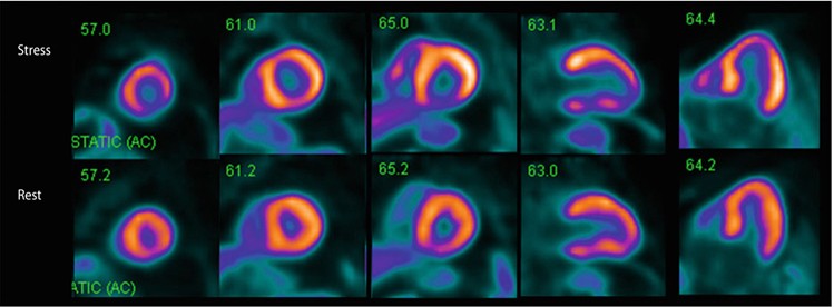 Kardiovaskulare Pet Ct In Den Usa Springerlink